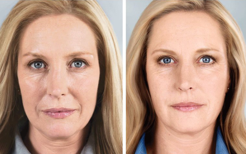 Glo Med Aesthetics Sculptra Before After | Nevada City, CA