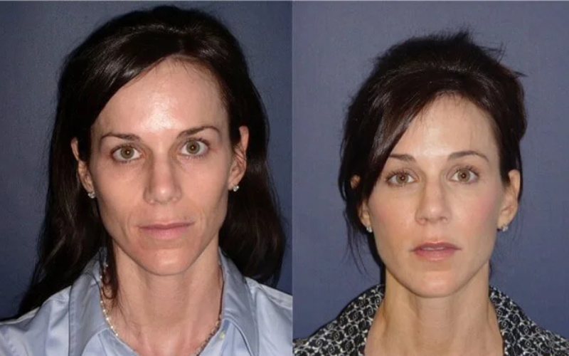 Glo Med Aesthetics | Sculptra Before After face in Nevada City, CA