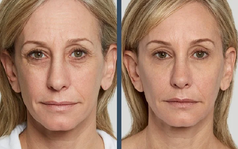 Glo Med Aesthetics | Sculptra Before After Women | Nevada City, CA