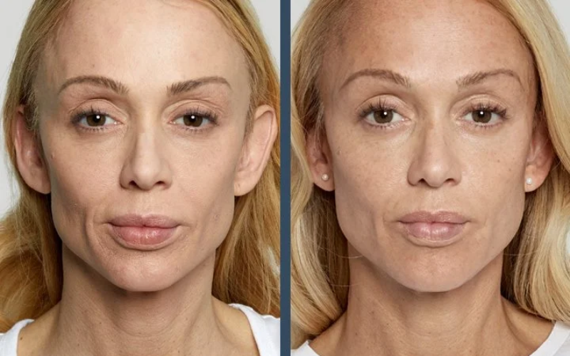 Glo Med Aesthetics | Sculptra Before After woman's face | Nevada City, CA