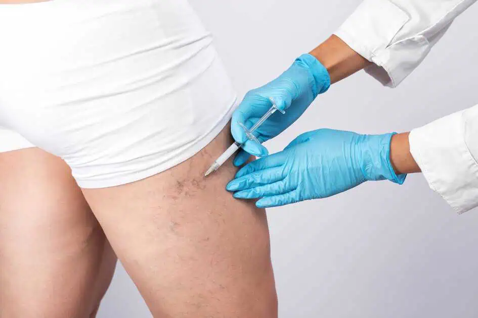 Sclerotherapy In Nevada City, CA by Glo Med Aesthetics