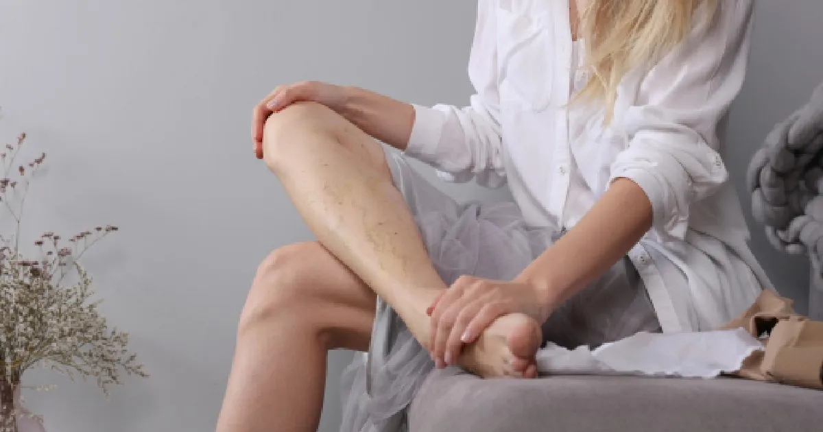 Women having Spider Veins in Nevada City, CA