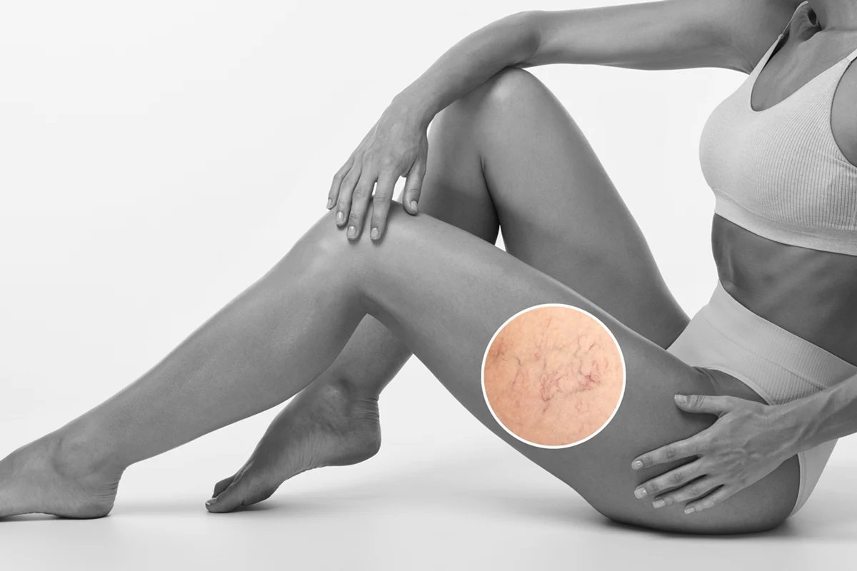 Visible reduction of leg spider veins shown