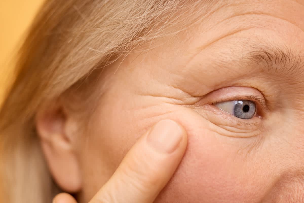 Botox treatment for reducing crow's feet and fine lines around the eyes