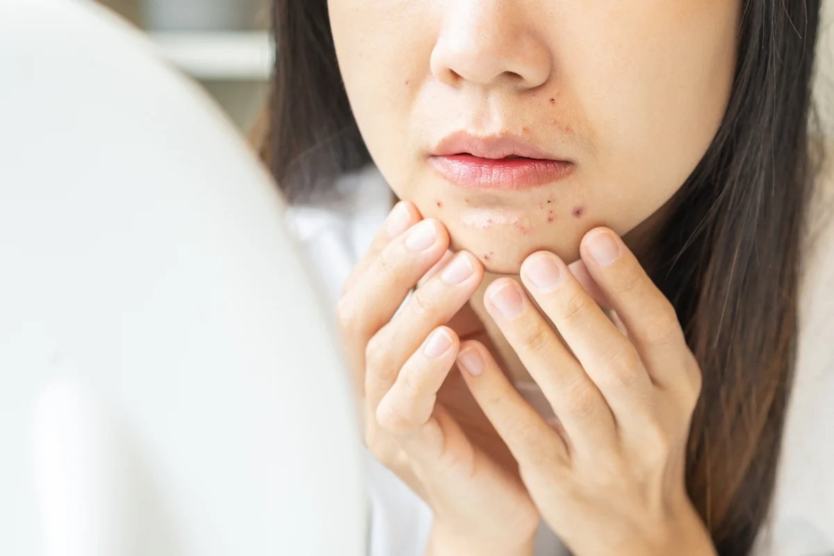 Woman showing her face acne while concerned about acne scar appearance